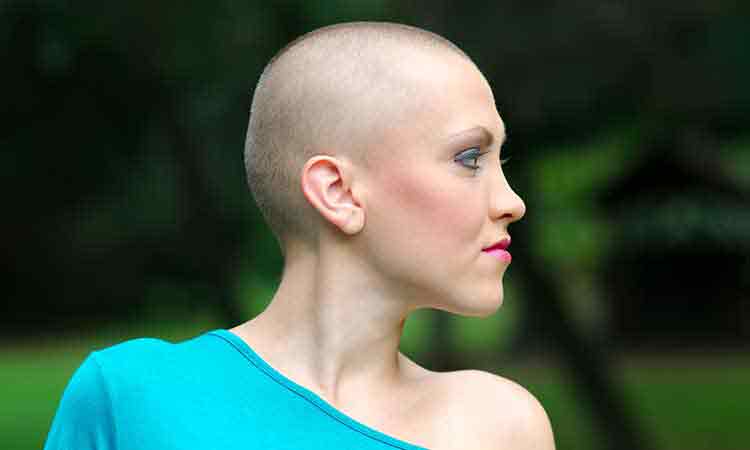 Alopecia_Feature-image-750x450-px_0