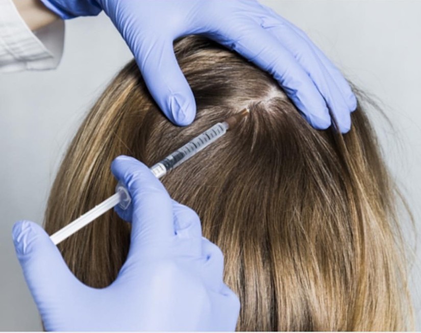 PRP-for-hair-loss-treatment